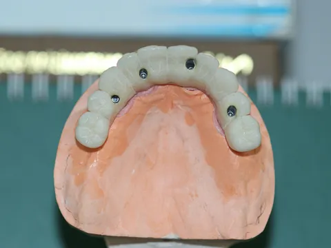 All-on-4 implants at Oral Surgery Group