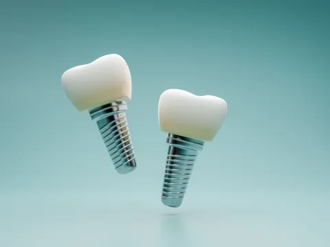 Dental implants at Oral Surgery Group