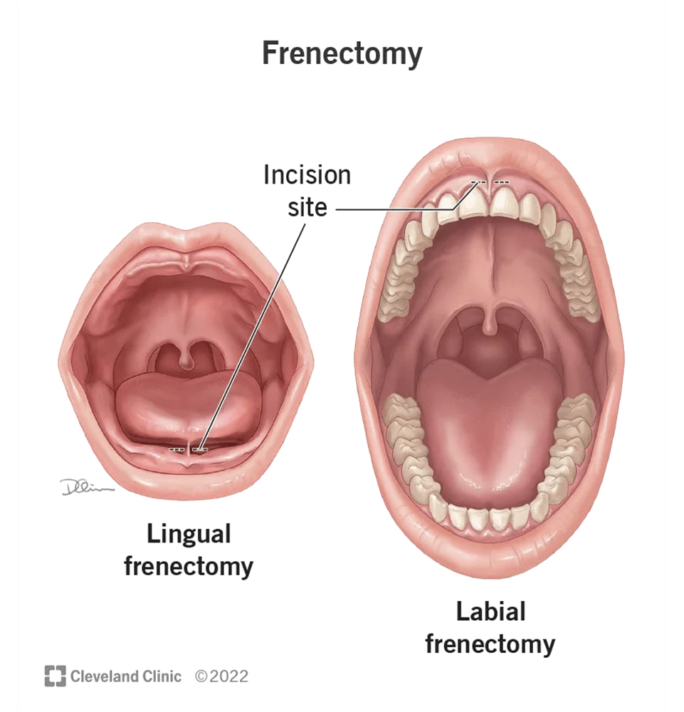 Frenectomy consultation at Oral Surgery Group
